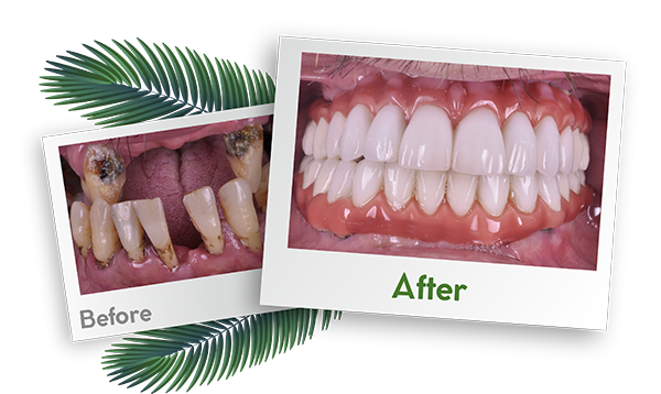 Turkey Dental Hospital Before After Images 2