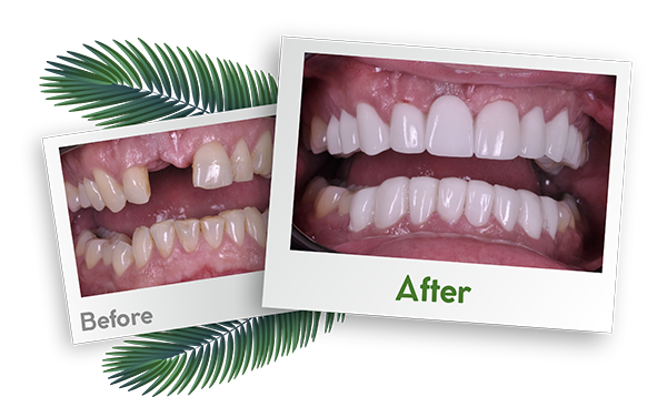 Turkey Dental Hospital Before After Images 5